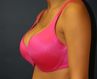 Breast Augmentation San Diego Case 47a - after - side