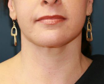Liposuction Neck San Diego Case 11 - after - front