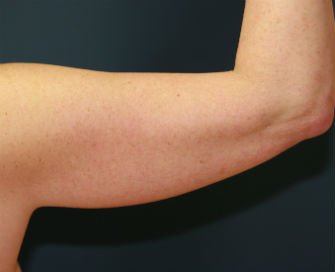 Liposuction right arm - before - back