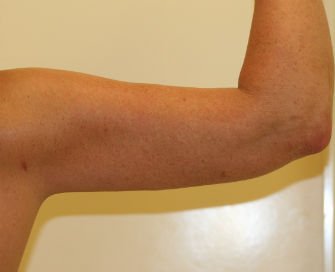 Liposuction right arm - after - back