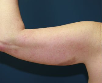 Liposuction left arm - before - back