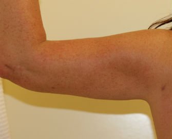 Liposuction left arm - after - back
