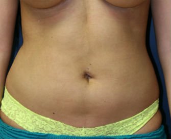 Liposuction abdomen - after - front