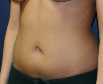Liposuction abdomen - before - oblique