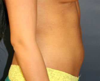 Liposuction abdomen - after - side