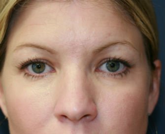 Eyelid Surgery San Diego Case 49 - before - front