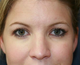 Eyelid Surgery San Diego Case 49 - after - front
