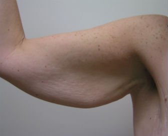 Arms 1 - before - front