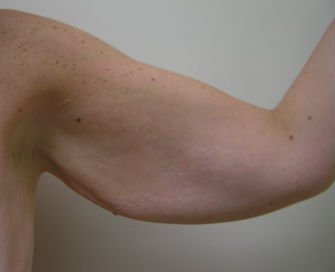 Arm reduction San Diego Case 2 - before - front