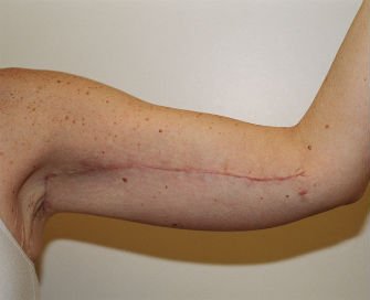 Arm reduction San Diego Case 2 - after - front