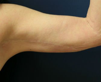 Arm reduction San Diego Case 3 - after - front