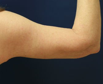 Arm reduction San Diego Case 4 - after - back