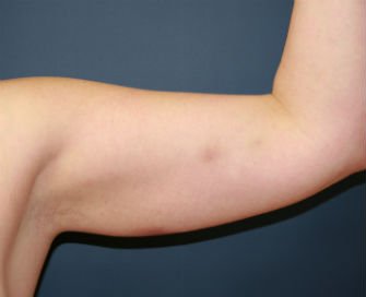 Arm reduction San Diego Case 6 - before - front