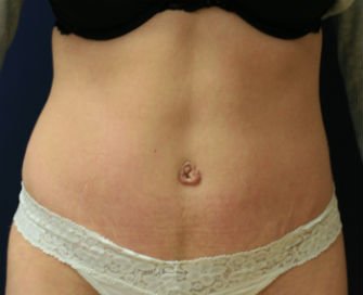 Tummy Tuck San Diego Case 37 - after - front
