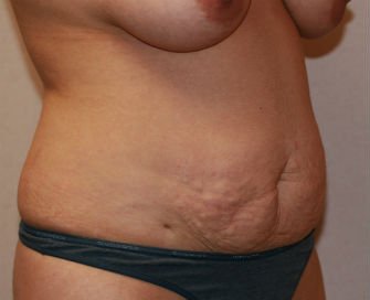 Tummy Tuck San Diego Case 37 - before - oblique