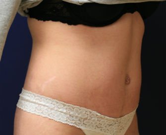 Tummy Tuck San Diego Case 37 - after - oblique