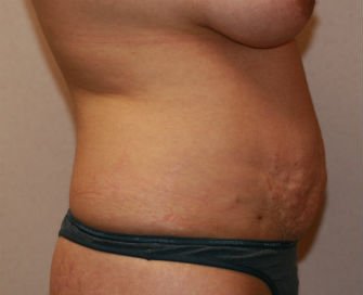 Tummy Tuck San Diego Case 37 - before - side