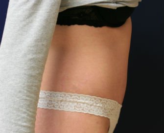 Tummy Tuck San Diego Case 37 - after - side