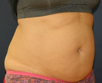 Tummy Tuck San Diego Case 38 - before - oblique