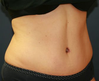 Tummy Tuck San Diego Case 38 - after - oblique