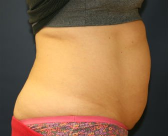 Tummy Tuck San Diego Case 38 - before - side