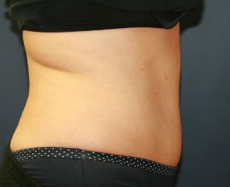 Tummy Tuck San Diego Case 38 - after - side