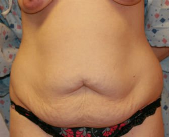 Tummy Tuck San Diego Case 39 - before - front