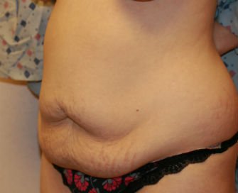 Tummy Tuck San Diego Case 39 - before - oblique