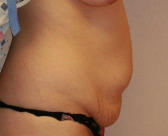Tummy Tuck San Diego Case 39 - before - side