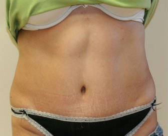 Tummy Tuck San Diego Case 40 - after - front