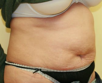 Tummy Tuck San Diego Case 40 - before - oblique