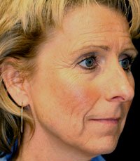 Facelift Case 6 - before - angle