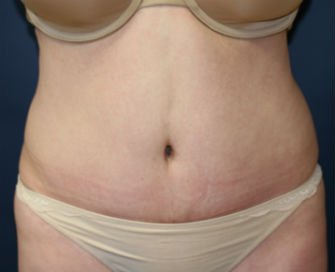 Tummy Tuck San Diego Case 41 - after - front