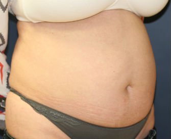 Tummy Tuck San Diego Case 41 - before - oblique