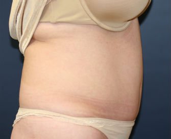 Tummy Tuck San Diego Case 41 - after - side