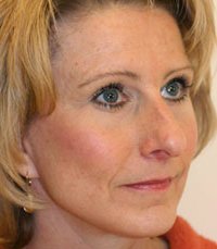 Facelift Case 6 - after - angle