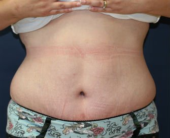 Tummy Tuck San Diego Case 42 - after - front