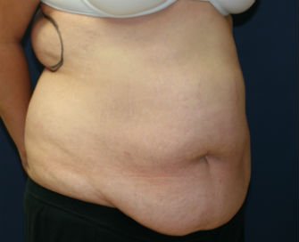 Tummy Tuck San Diego Case 42 - before - oblique