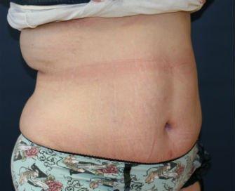 Tummy Tuck San Diego Case 42 - after - oblique