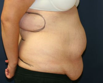Tummy Tuck San Diego Case 42 - before - side