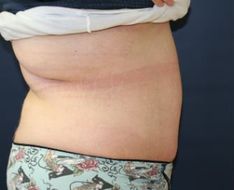 Tummy Tuck San Diego Case 42 - after - side