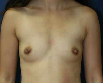 Breast Implants San Diego, Case 65 - before - front