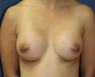 Breast Implants San Diego, Case 65 - after - front