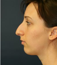 Rhinoplasty San Diego Case 30 - before - front