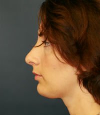 Rhinoplasty San Diego Case 30 - after - front