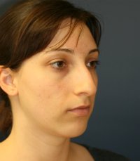 Rhinoplasty San Diego Case 30 - before - oblique