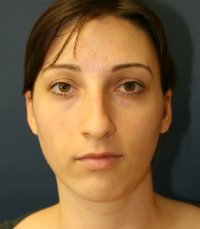 Rhinoplasty San Diego Case 30 - before - side
