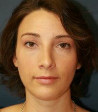 Rhinoplasty San Diego Case 30 - after - side