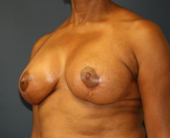 Breast Lift San Diego Case 18 - after - oblique