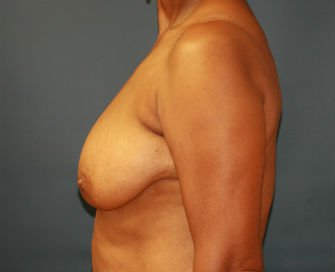 Breast Lift San Diego Case 18 - before - side